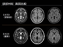 MRI画像